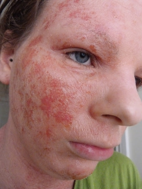 Guest Post: Living With Adult Eczema